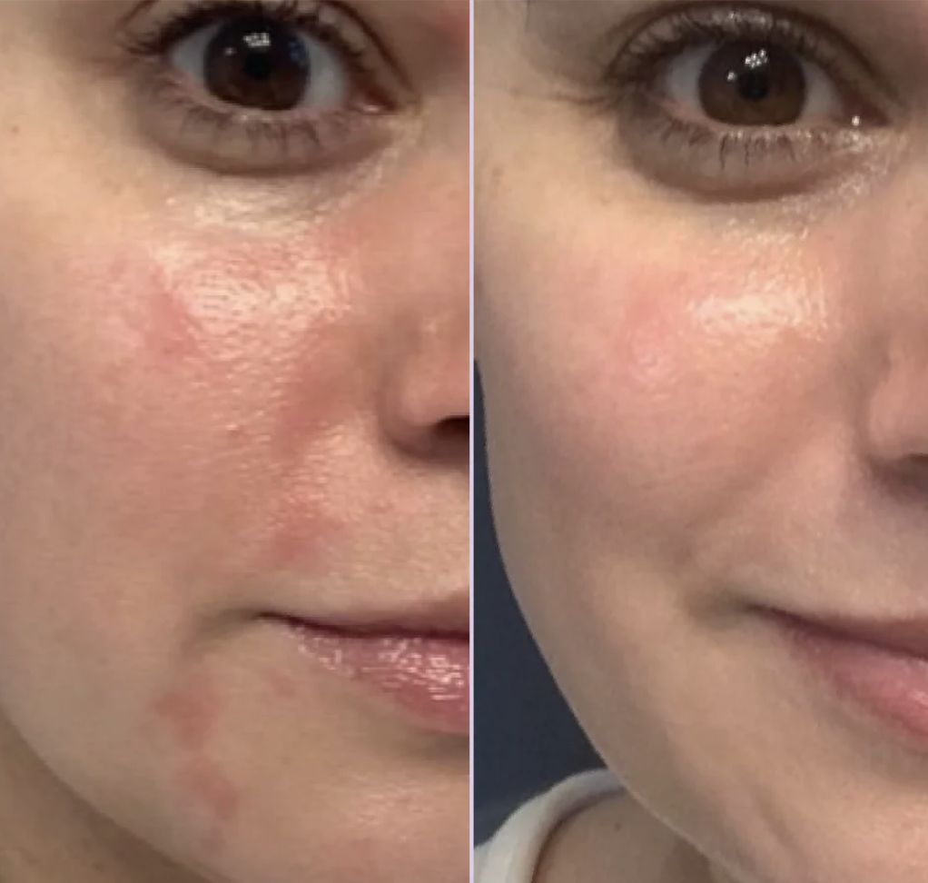 a before and after, a woman who had severe blemishes on her face and after when it is cleared up, purportedly from the Tower 28 spray. 